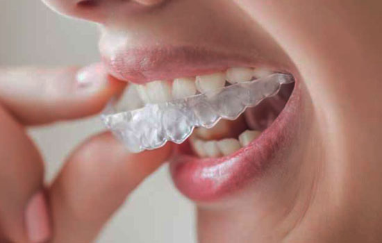 Bruxismo, tratamiento con férula Bruxismo, tratamiento con férula