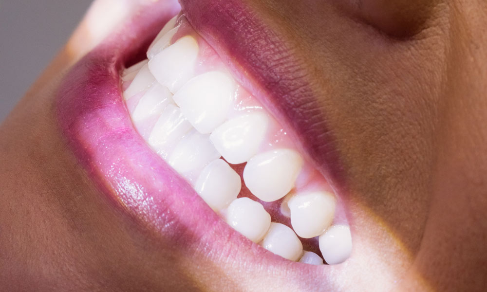 sonsrisa gingival