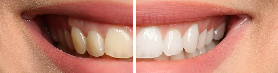 Blanqueamiento dental (antes y después)